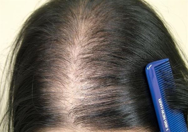 6 nguyên nhân gây rụng tóc ở nữ giới
