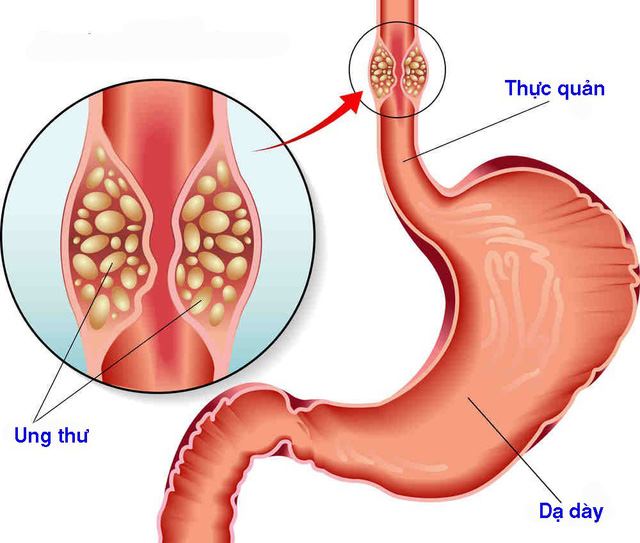 fucoidan chữa ung thư thực quản