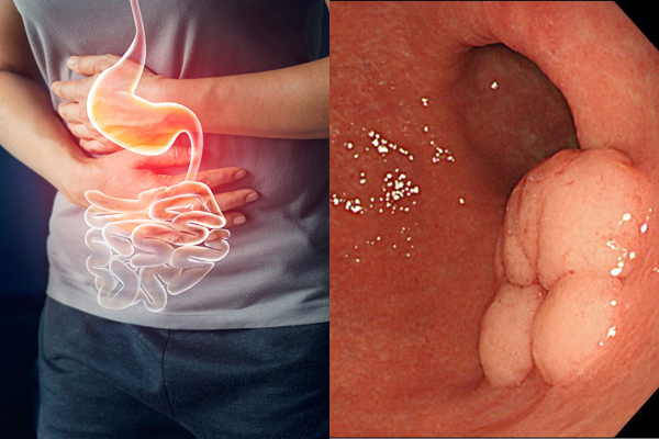 ung thư dạ dày giai đoạn 3