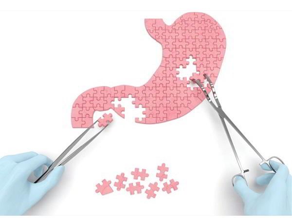 phẫu thuật dạ dày