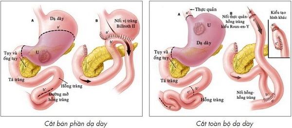 phẫu thuật ung thư dạ dày