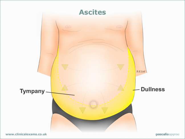 triệu chứng ung thư buồng trứng giai đoạn cuối