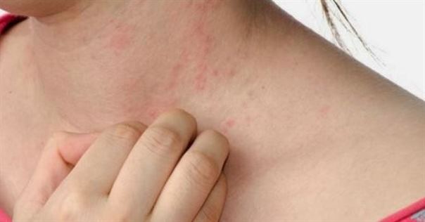 triệu chứng ung thư gan giai đoạn đầu dị ứng và mẩn ngứa