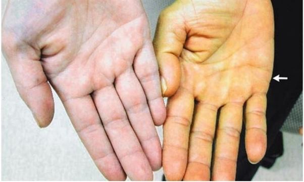 triệu chứng ung thư gan giai đoạn đầu