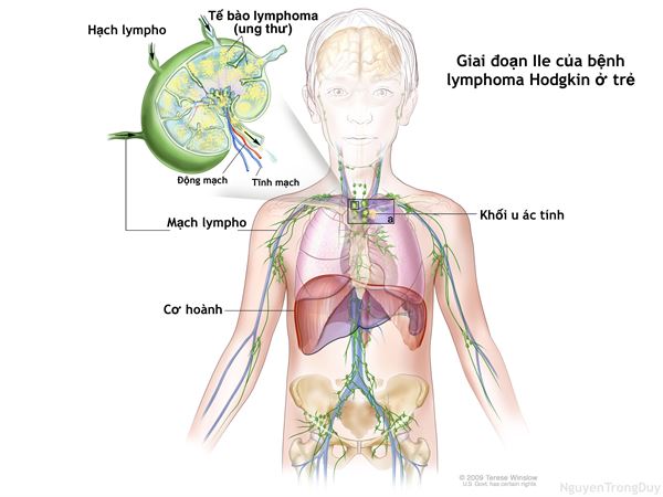 hodgkin's lymphoma là gì