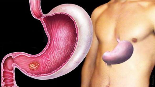 ung thư biểu mô tuyến dạ dày