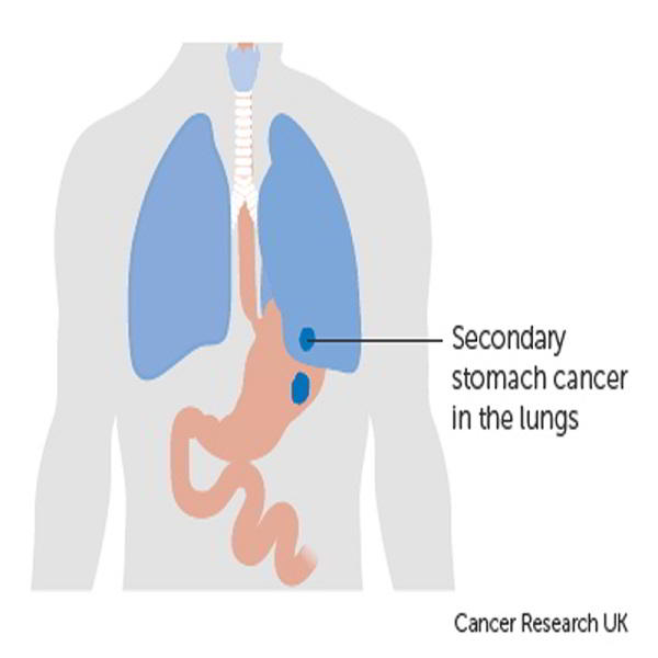 ung thư dạ dày giai đoạn 4