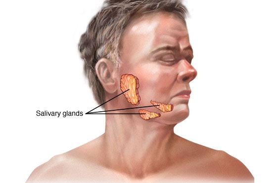 ung thư tuyến nước bọt