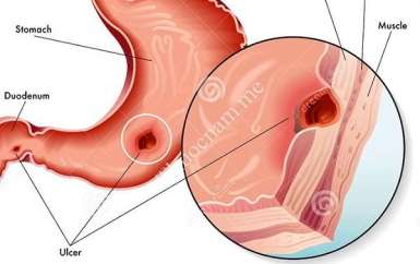 Toàn bộ các kiến thức cần biết về Ung thư dạ dày giai đoạn 2 Toàn bộ các kiến thức cần biết về Ung thư dạ dày giai đoạn 2