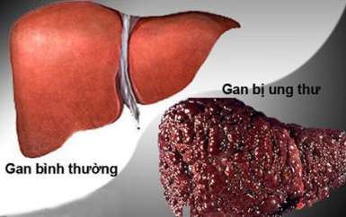Sự tiến triển và di căn ung thư gan qua các giai đoạn 1234