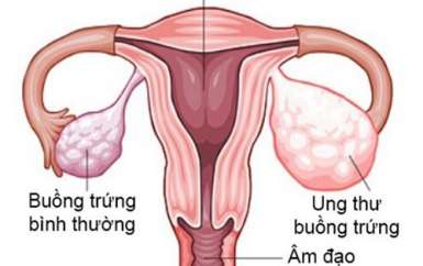Kể tên 8+ nguyên nhân gây ung thư buồng trứng giúp bạn nữ cảnh giác từ sớm Kể tên 8+ nguyên nhân gây ung thư buồng trứng giúp bạn nữ cảnh giác từ sớm