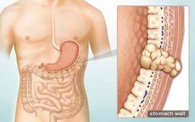 Hiểu tường tận về ung thư dạ dày giai đoạn đầu qua 5 câu hỏi