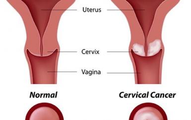 Nguyên nhân và Cách phòng ngừa Ung thư cổ tử cung Nguyên nhân và Cách phòng ngừa Ung thư cổ tử cung