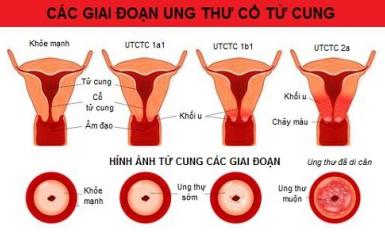 Khám và Tầm soát ung thư cổ tử cung Khám và Tầm soát ung thư cổ tử cung