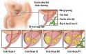 ung thư tiền liệt tuyến