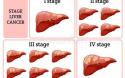 Tìm hiểu các các phân loại giai đoạn ung thư gan Tìm hiểu các các phân loại giai đoạn ung thư gan