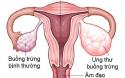 Kể tên 8+ nguyên nhân gây ung thư buồng trứng giúp bạn nữ cảnh giác từ sớm