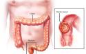 Giới thiệu chung về bệnh học Ung thư đại tràng - trực tràng