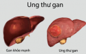 ung thư gan bị vỡ